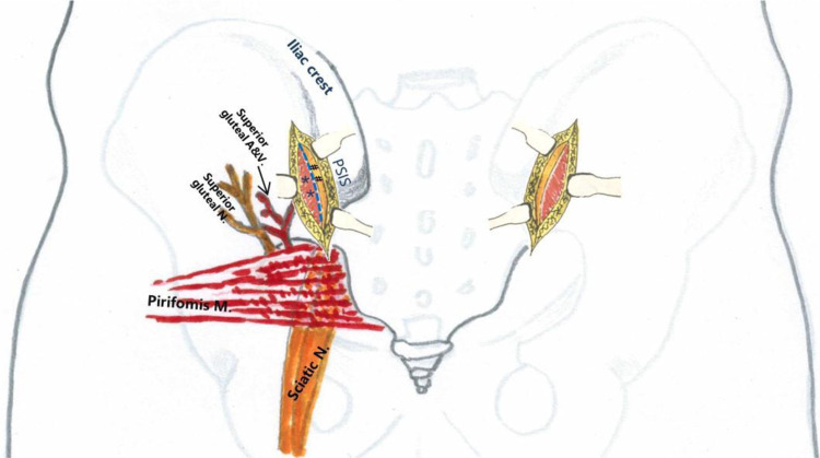 Posterior pelvic ring fixation: evolution of surgical approaches and evidence-based outcomes for unstable fractures.