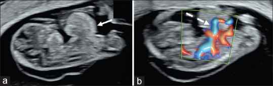 A Pattern of Malformations in the First Trimester Ultrasound.