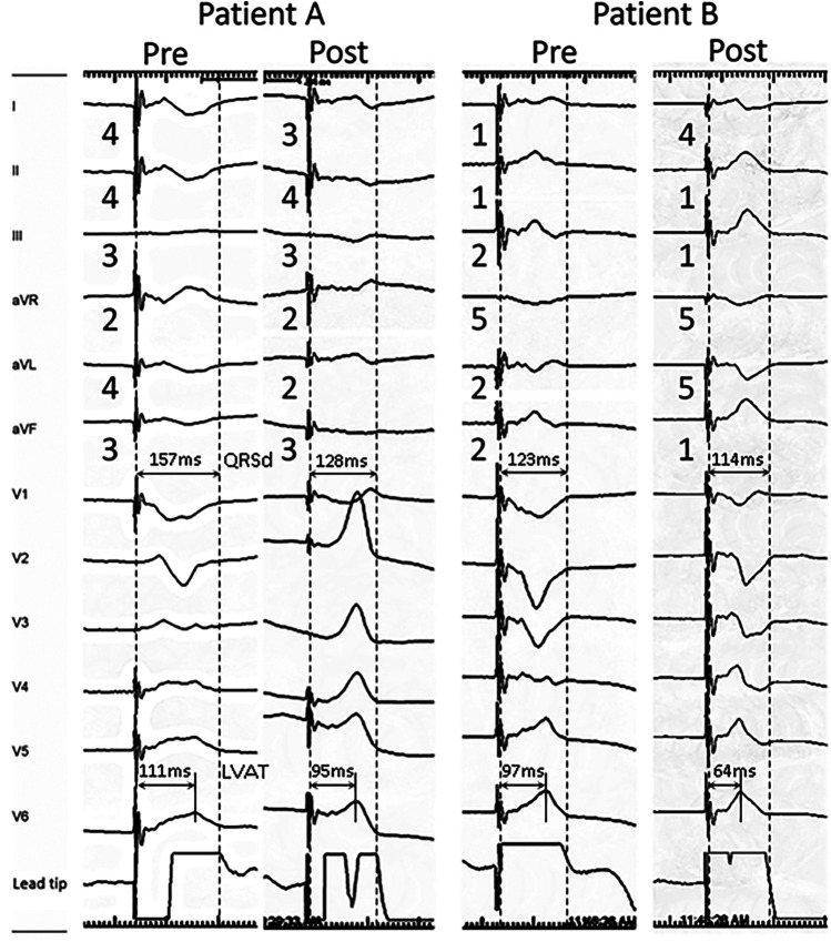 Role of peri-deployment right ventricular paced-ECG in left bundle area pacing.