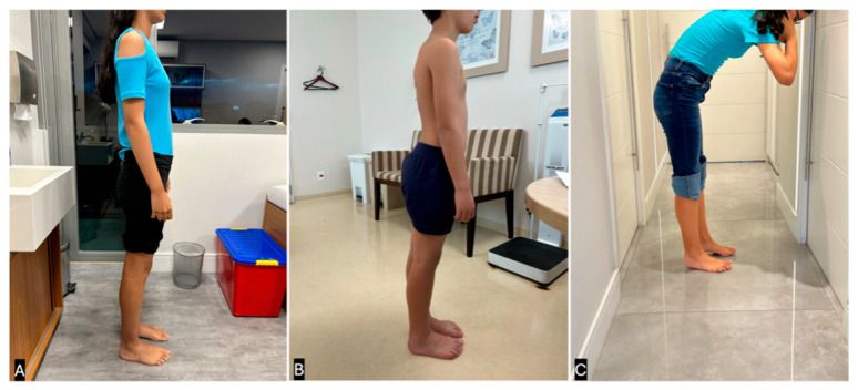 The Autistic Toe Walking: A Narrative Review for Interventions and Comparison with Idiopathic Toe Walking.