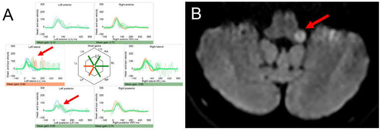 Acute Vertigo, Dizziness and Imbalance in the Emergency Department-Beyond Stroke and Acute Unilateral Vestibulopathy-A Narrative Review.