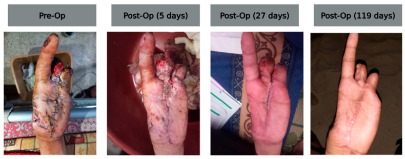 Utilization of a Multi-Tissue Extracellular Matrix in Complex Wound Care in Gaza: A Case Series.
