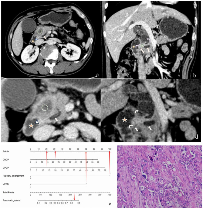 Differentiating pancreatic from periampullary non-pancreatic cancer: a nomogram-based prediction model utilizing CT imaging.