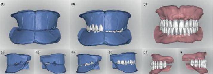 CAD-CAM Complete Dentures Manufactured Using Additive and Subtractive Manufacturing Techniques: A Feasible Clinical Approach for Managing Geriatric Patients With Advanced Residual Ridge Resorption.