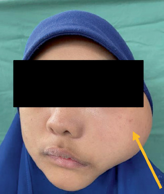 Odontogenic Fibromyxoma in a Pediatric Patient: A Rare Aggressive Neoplasm With Recurrent and Fatal Outcome.