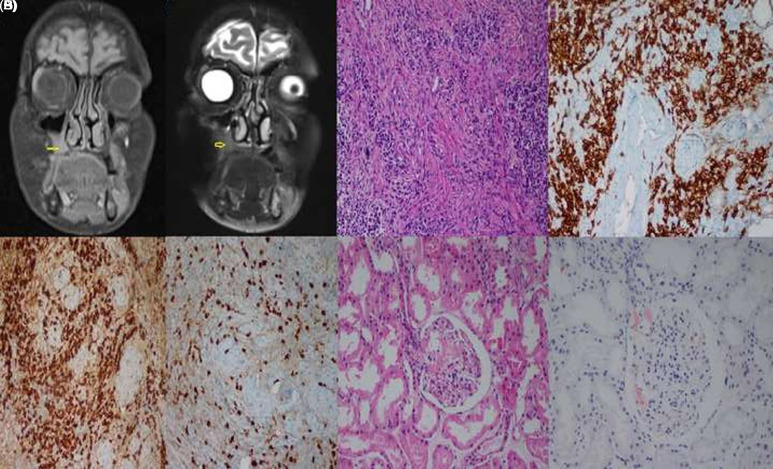 Occurrence of 2 Uncommon Findings in a Patient With Immunoglobulin G4-Related Disease: Maxillary Sinus Involvement and AA (Amyloid A) Amyloidosis.