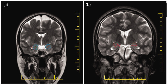 A direct association between suicide and reduced amygdala volume: A retrospective study.