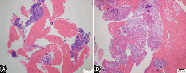 A retrospective study on the comparative use of fine-needle biopsy and aspiration for the diagnosis and classification of malignant lymphoma in Japan.
