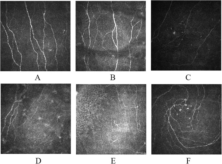 Development of Diagnostic Nomograms Using Corneal Nerve Parameters for Diabetic Peripheral Neuropathy in Type 2 Diabetes Mellitus.
