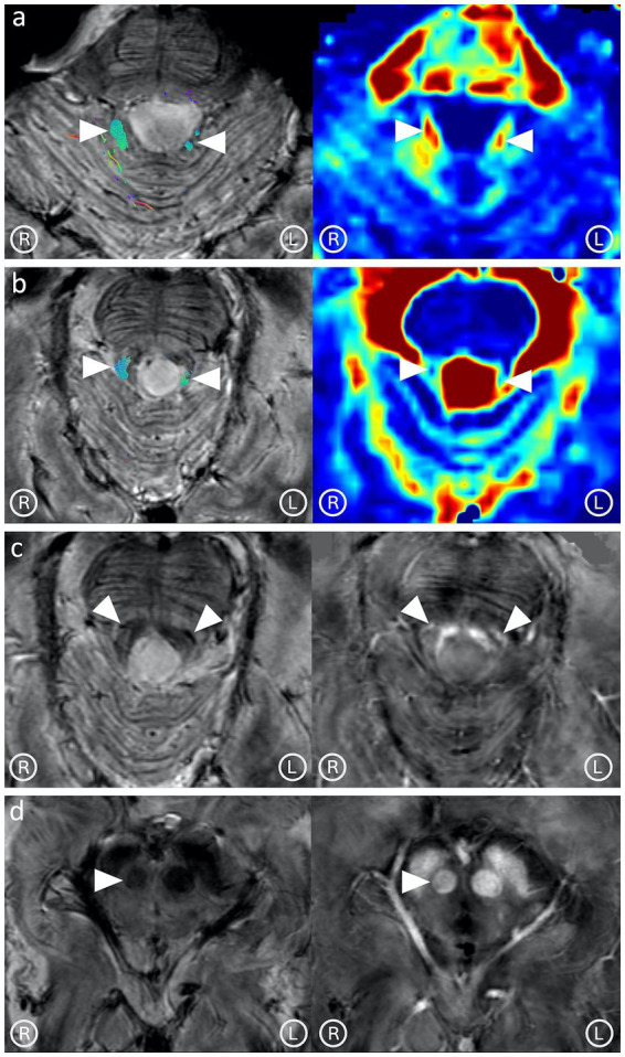 Hypertrophic olivary degeneration: a 7 Tesla advanced imaging case report.