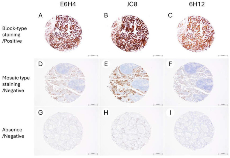 Comparative Evaluation of Three Primary Antibody Clones for p16 Immunohistochemistry in Gynecologic Tumors.