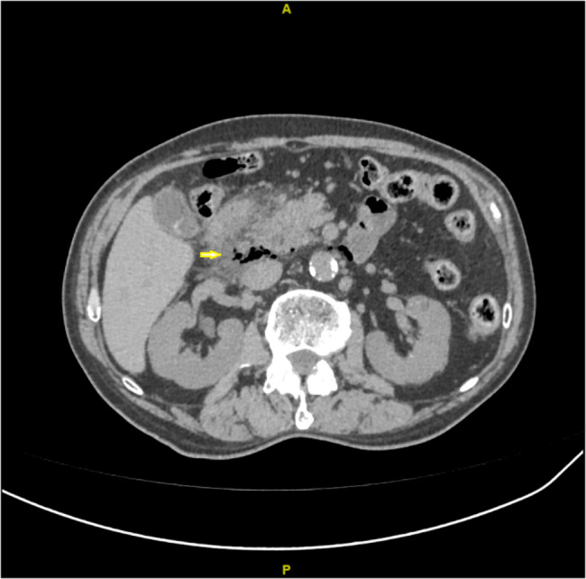 The submission title: management of retroperitoneal perforated descending duodenal diverticulum using de pezzer catheter drainage combined with nutritional jejunostomy: a case report and review of the literature.