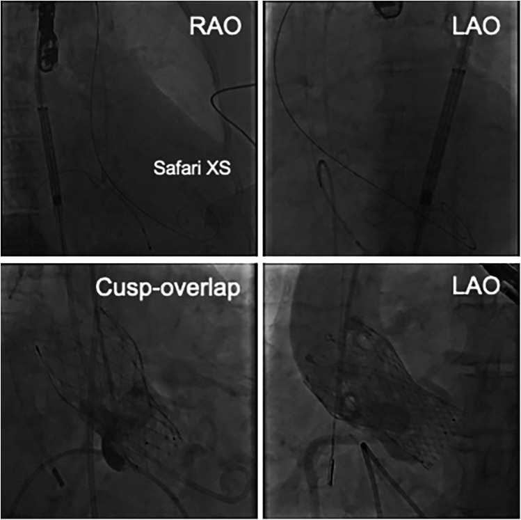 Assessment and treatment of left ventricular pseudoaneurysm due to wire injury in transcatheter aortic valve implantation: a case report.