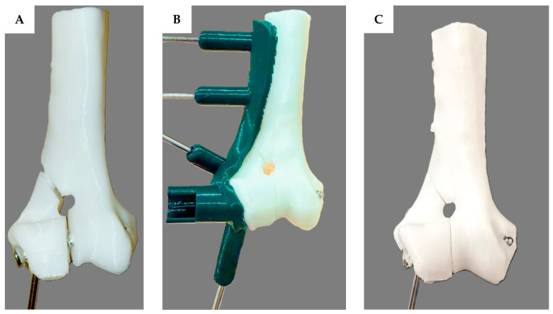 Effectiveness of Custom-Designed 3D-Printed Drill Guides in the Treatment of Lateral Humeral Condylar Fractures in a French Bulldog Bone Model.