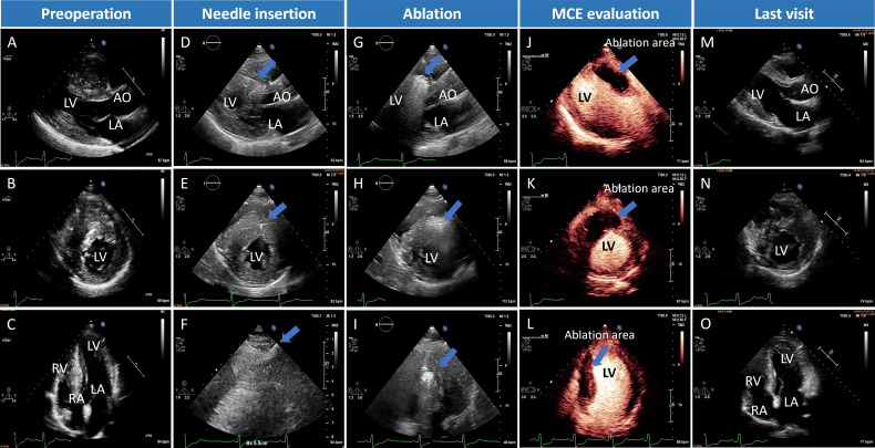 Percutaneous intramyocardial septal radiofrequency ablation: a novel treatment for drug-refractory non-obstructive hypertrophic cardiomyopathy with severe septal hypertrophy.
