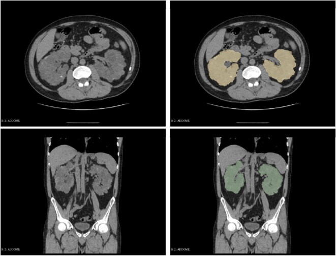 A novel CT-based radiomics approach for kidney function evaluation in ADPKD: a pilot study.