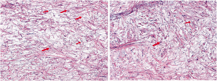 A case report of desmoplastic fibroblastoma in a 2-year-old child.