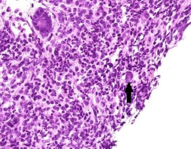 Relationship between adenovirus infection and intussusception via pathological evidence confirms.