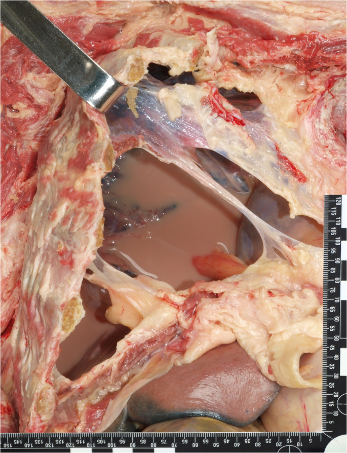 An alternative method to differentiate pleural effusion after leakage of artificial enteral nutrition formula.