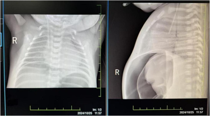 Prolonged resuscitation and systemic management of multi-organ dysfunction in a neonate with severe asphyxia: a case report.