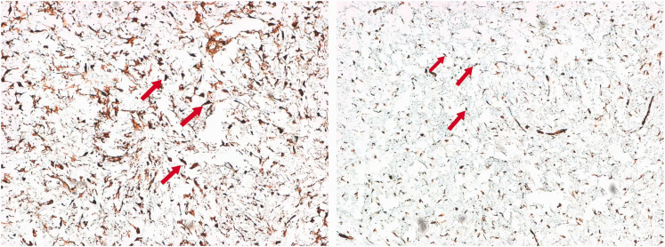 A case report of desmoplastic fibroblastoma in a 2-year-old child.