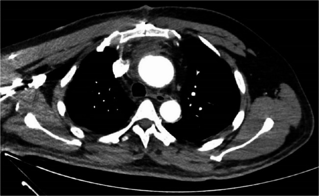 Aortic dissection disguised as musculoskeletal condition: a case report and review of literature.