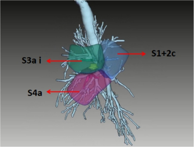 Application of preoperative three-dimensional reconstruction in single-port video-assisted thoracoscopic complex segmentectomy: a propensity matching analysis.