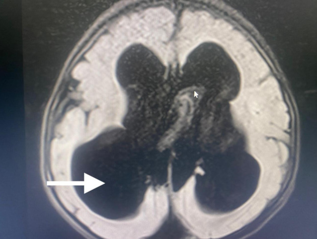 Anesthesiologist's Concerns About Dandy-Walker Syndrome: Airway Management, Muscle Relaxants, and Train-of-Four Monitoring of Neuromuscular Blockade.