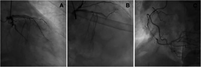 A rare coincidence of presentation of TIA like illness immediately followed by acute myocardial infarction and cardiac arrest: a case report.
