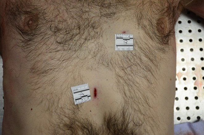 A rare complication of a thoracic wound: the pneumopericardium?
