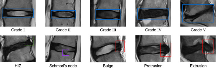 Enhancing LDD diagnosis with YOLOv9-AID: simultaneous detection of pfirrmann grading, disc herniation, HIZ, and Schmorl's nodules.