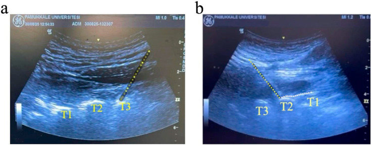 Comprehensive Assessment of Pain and Physiological Parameters of Sympathetic Blockade to Accurately Determine the Success of High Thoracic Erector Spinae Plane Block.