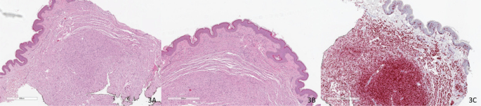 Multiple Papules and Nodules in a Dermatomal Distribution: A Quiz.