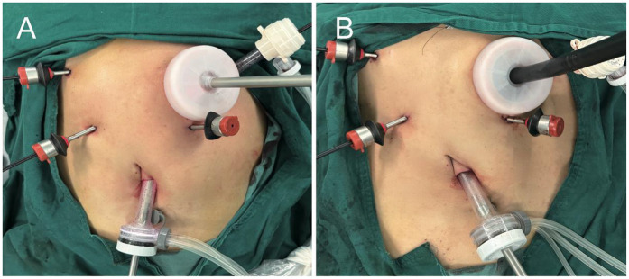Intracorporeal circular-stapled gastroduodenostomy for billroth I reconstruction in total laparoscopic distal gastrectomy.