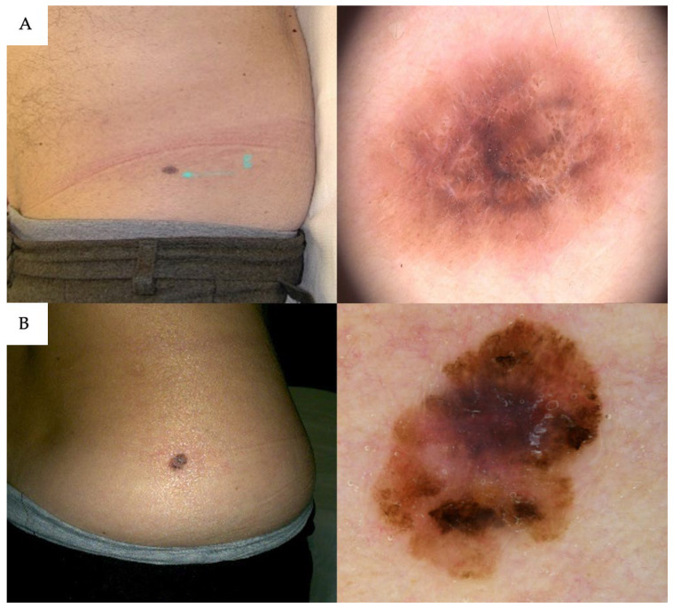 Melanoma Clues Beyond Dermoscopic Patterns: Lesion Orientation to Langer's Lines as a Predictor on the Trunk.