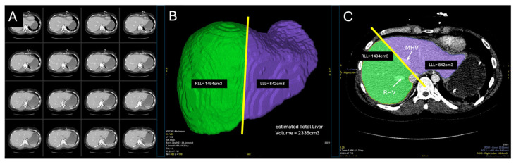 Ex-Situ Dual Hypothermic Oxygenated Machine Perfusion in Full-Left-Full-Right Split Liver Transplantation for Two Adult Recipients.