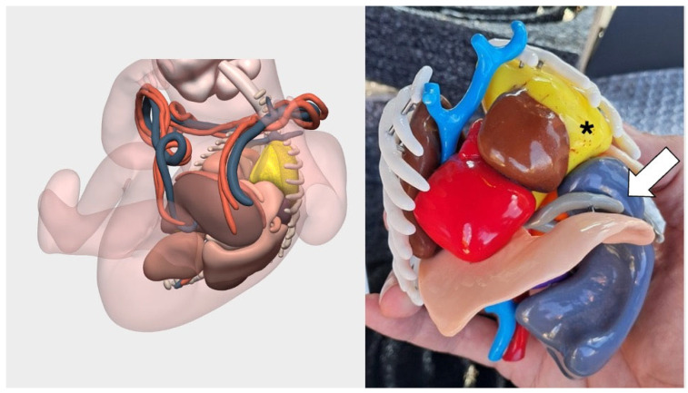 Clinical Impact of Patient-Specific 3D Models in Neonatal Surgery: A Case-Based Review of Applications and Future Directions.