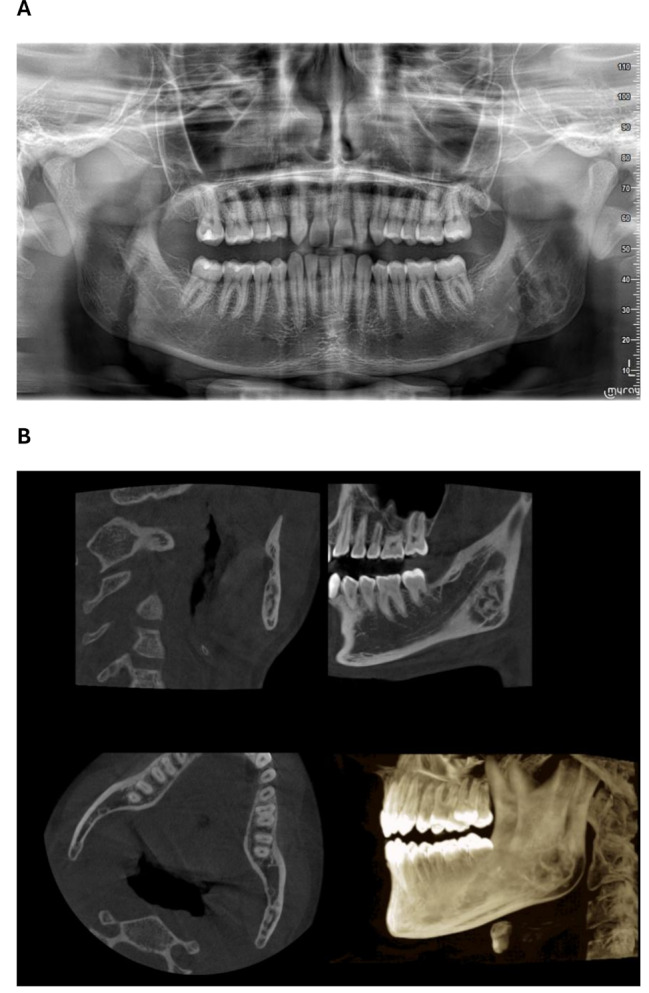 Xanthogranulomatous osteomyelitis of the jaw in a young boy: a case report.