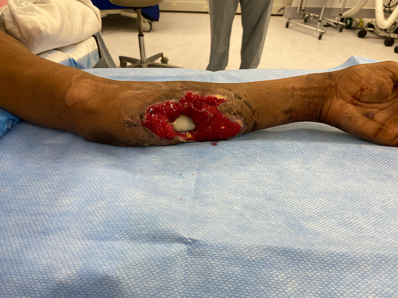 Novel Split Latissimus Dorsi Myocutaneous Flap After High-velocity Ballistic Injury With Functional Deficit: Retrospective Case Series.