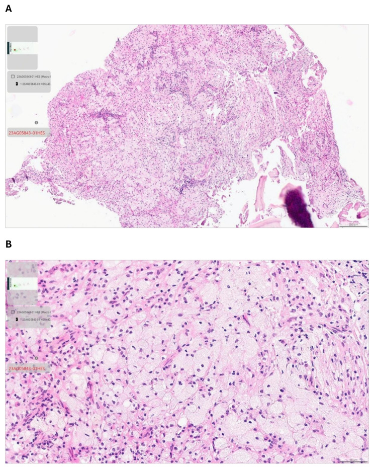 Xanthogranulomatous osteomyelitis of the jaw in a young boy: a case report.