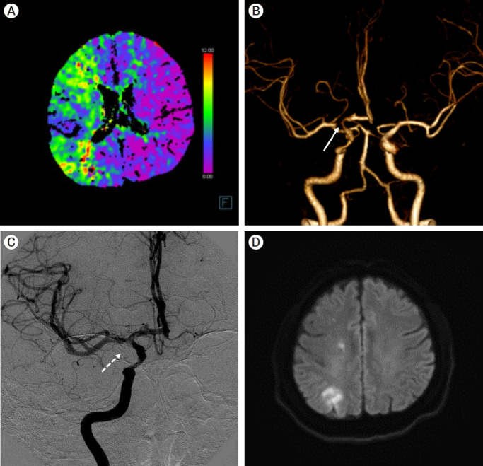 Superficial temporal artery-middle cerebral artery bypass for progressive cerebral infarction in invasive aspergillosis-induced total occlusion of internal carotid artery: A rare case and literature review.
