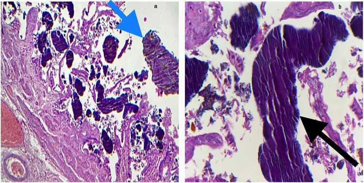 Actinomycosis of the Gallbladder in a Young Diabetic Woman with Acute Lithiasis Cholecystitis: A Case Report and Review of the Literature.