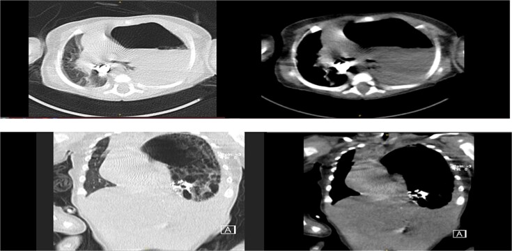 Tension gastrothorax in a late-presenting congenital diaphragmatic hernia: a case report and review of the literature.