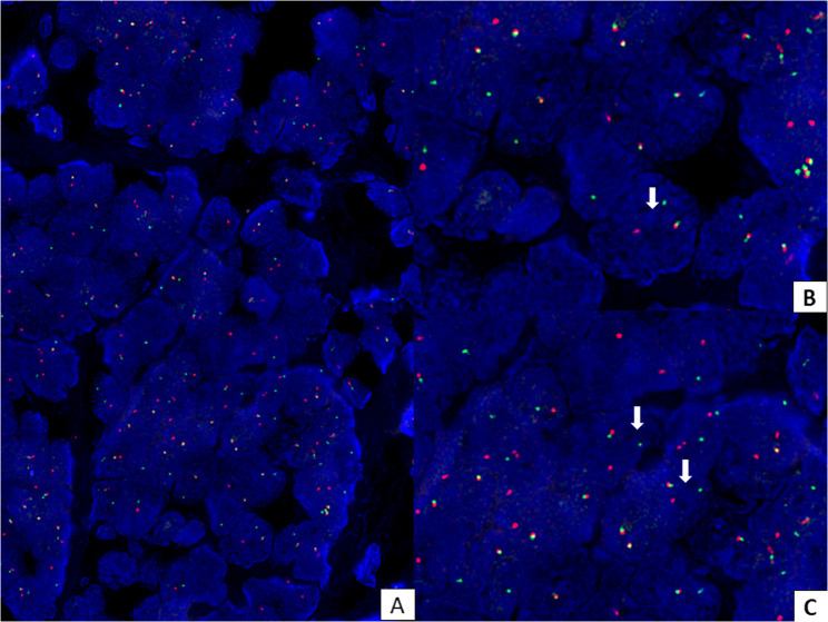 "Ewing's sarcoma of the duodenum: a rare gastrointestinal presentation": case report and review of literature.