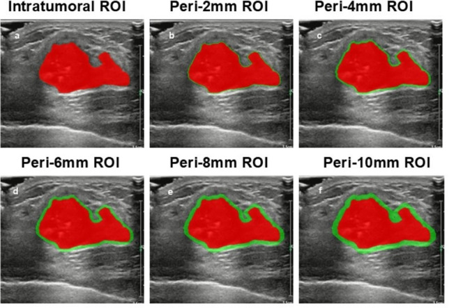 Intratumoral and peritumoral radiomics based on 2D ultrasound imaging in breast cancer was used to determine the optimal peritumoral range for predicting KI-67 expression.