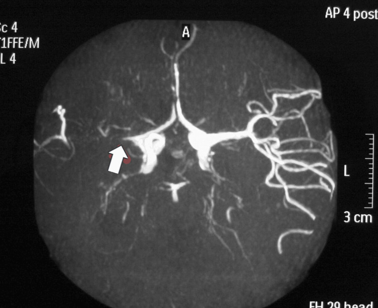Moyamoya Disease in Pregnancy: A Case Report and Review of the Literature.