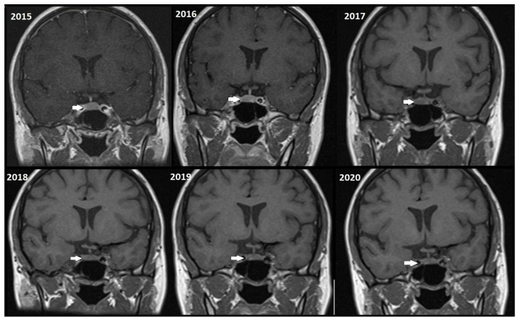 Rethinking MRI Protocols for Pituitary Microadenomas: Prioritizing Non-Contrast Imaging for Safe Follow-Up.