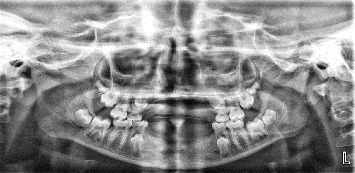 Oligodontia Management in a Resource-Limited Setting: Two Case Reports and Review of Literature.