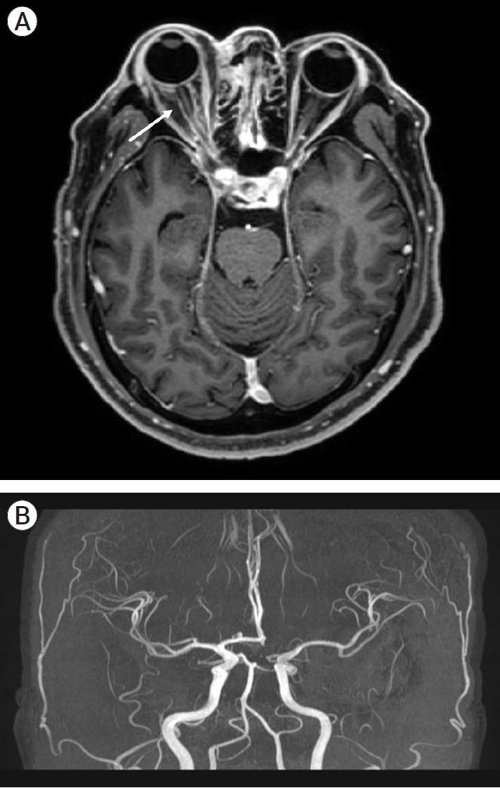 Superficial temporal artery-middle cerebral artery bypass for progressive cerebral infarction in invasive aspergillosis-induced total occlusion of internal carotid artery: A rare case and literature review.