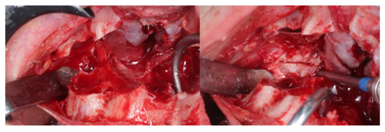 Evaluation of the Upper Airway in Class II Patients Undergoing Maxillary Setback and Counterclockwise Rotation in Orthognatic Surgery.